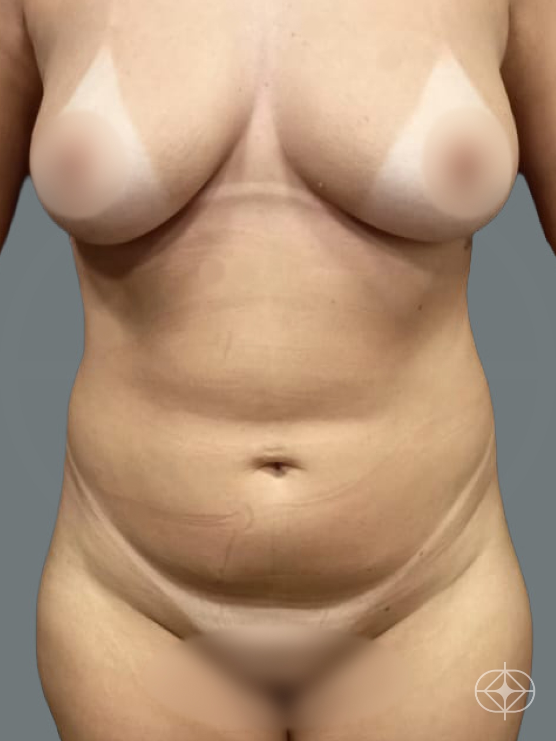 Foto antes de Lipoaspiração / Lipo HD realizado por Dr. Vinicius Spiandorello