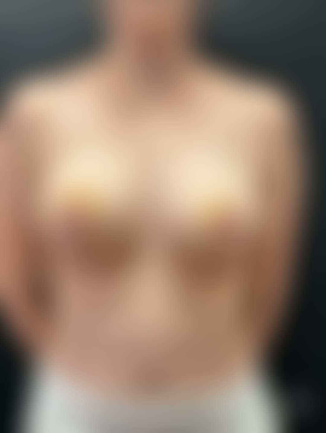 Resultado após Mamoplastia Redutora realizado por Dr. Henrique Riggenbach Muller