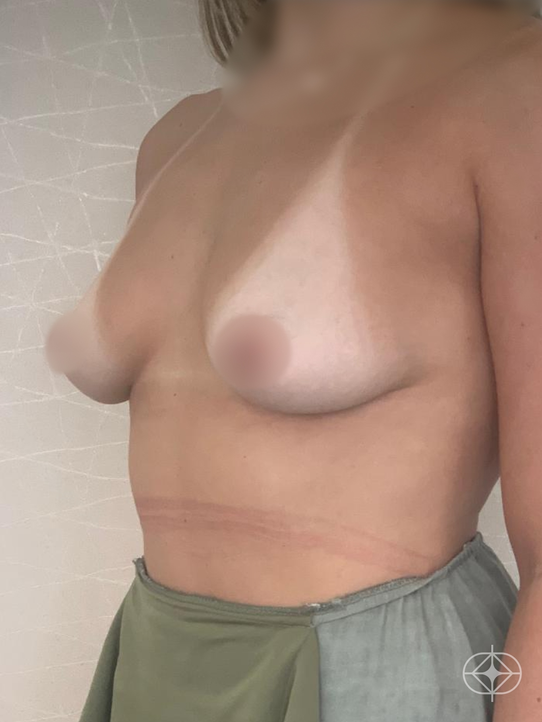 Foto antes de Mastopexia com Prótese (silicone) realizado por Dr. Manoel Bizerra