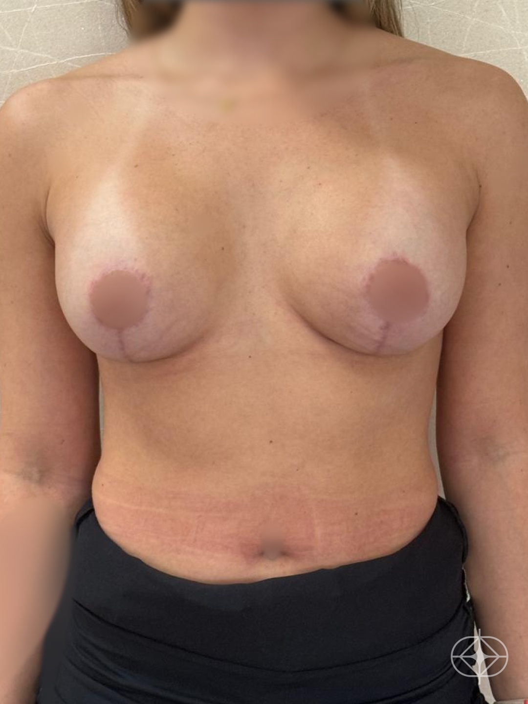 Resultado após Mastopexia com Prótese (silicone) realizado por Dr. Manoel Bizerra