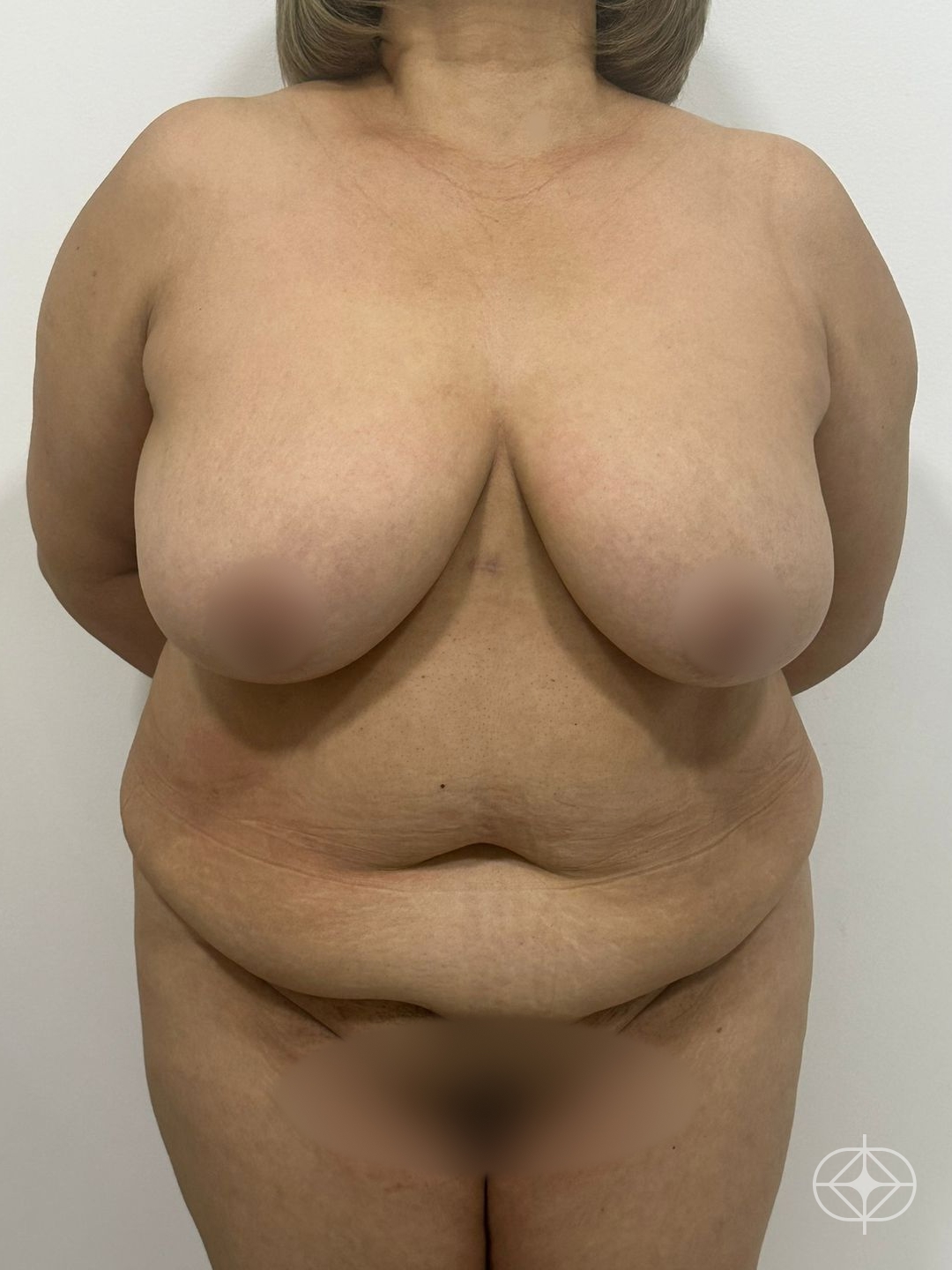 Foto antes de Mamoplastia Redutora realizado por Dr. João Ferreira
