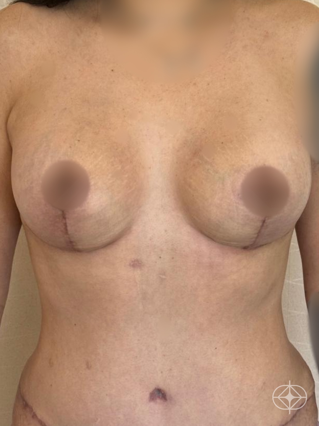 Resultado após Mastopexia com Prótese (silicone) realizado por Dr. Manoel Bizerra