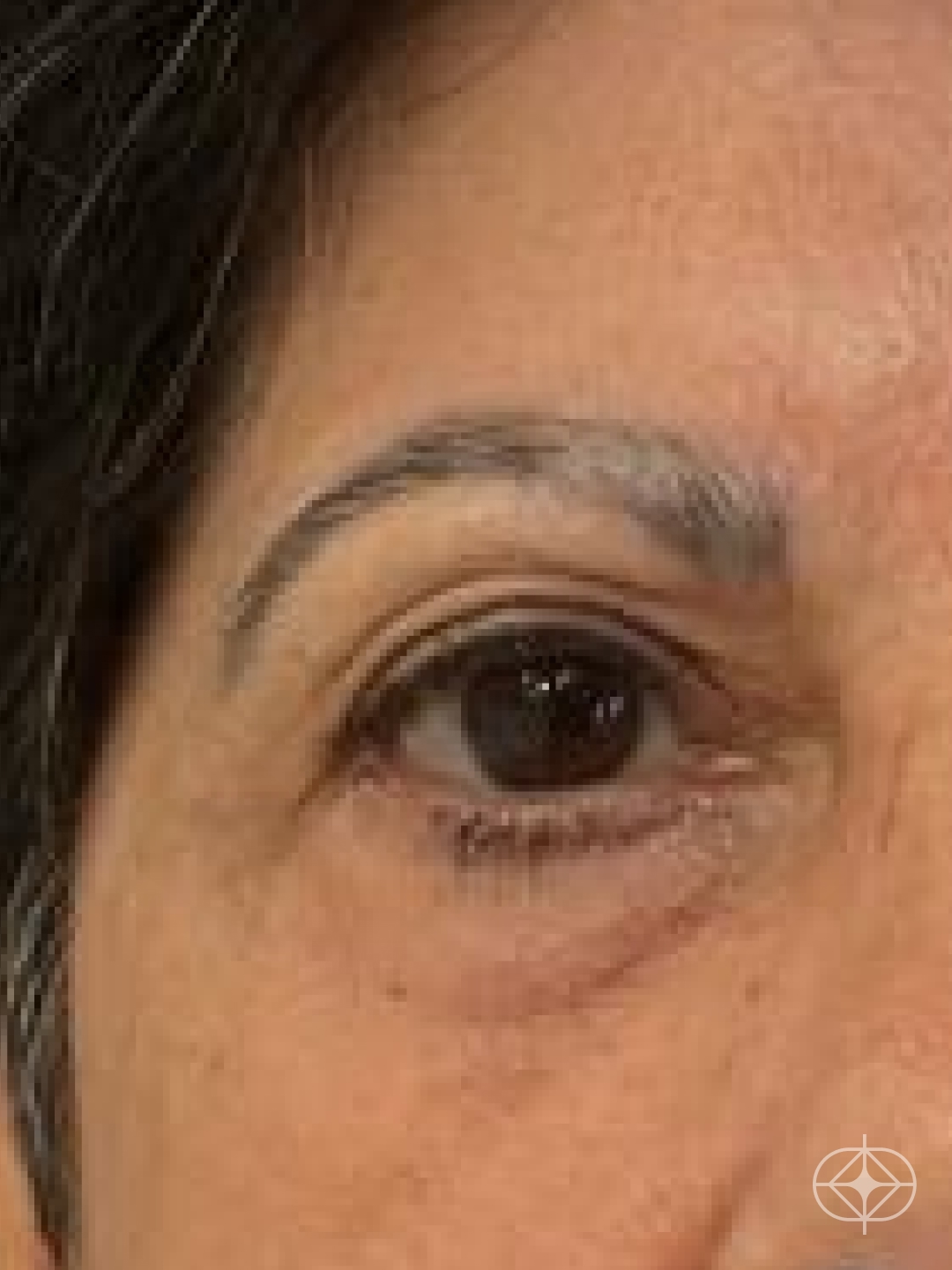 Foto antes de Blefaroplastia (olhos) realizado por Dra. Monica Renesto Fontana Do Amaral