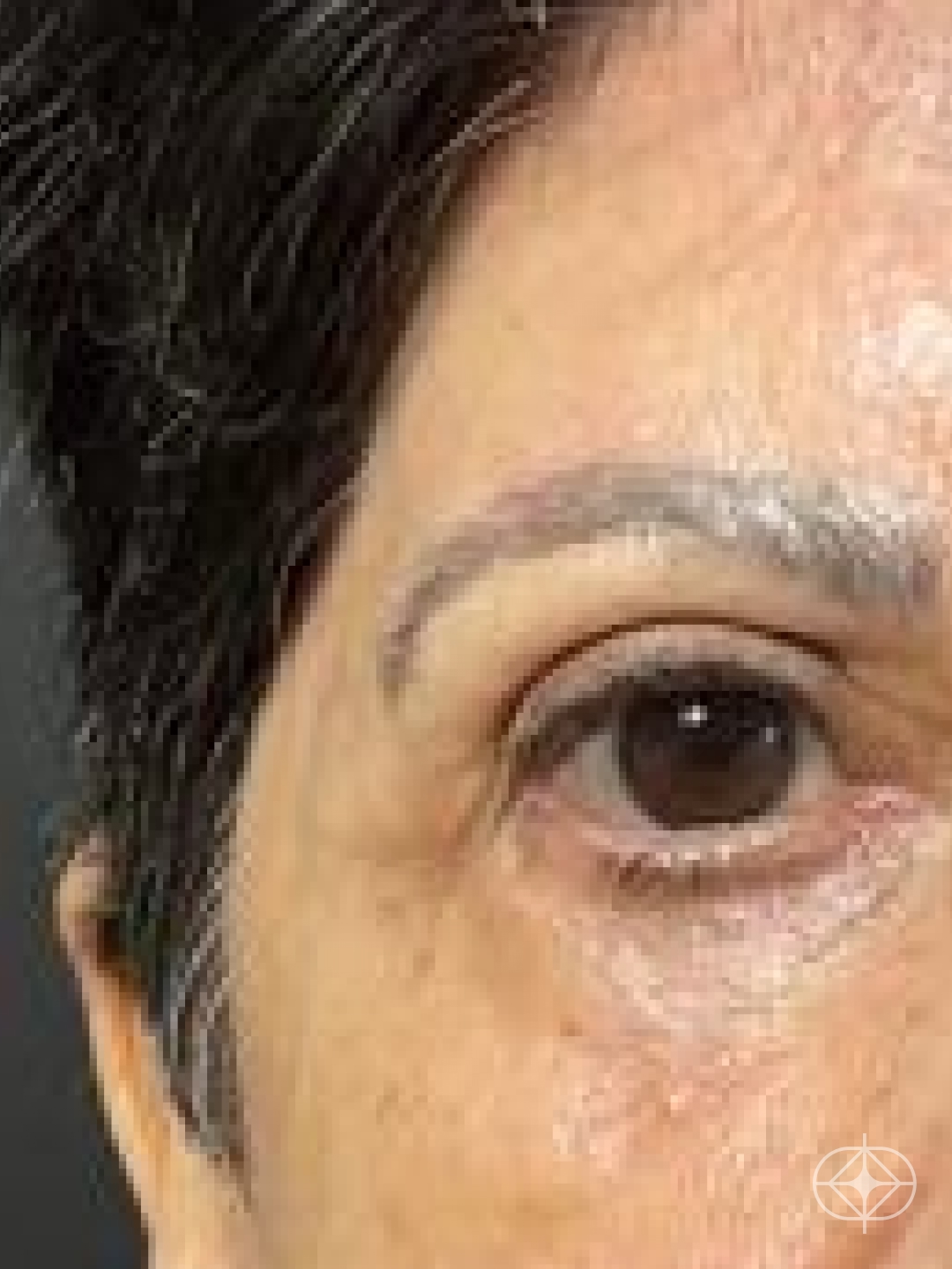 Resultado após Blefaroplastia (olhos) realizado por Dra. Monica Renesto Fontana Do Amaral