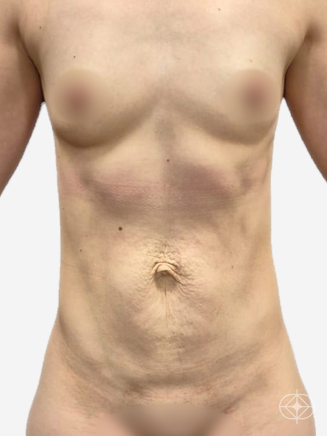 Foto antes de Lipoaspiração / Lipo HD realizado por Dr. Vinicius Spiandorello