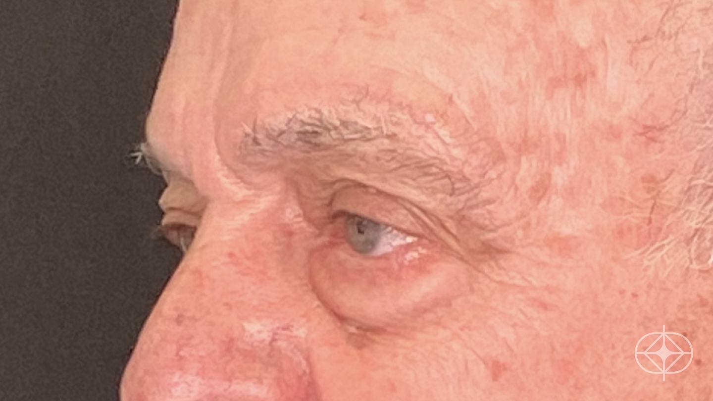 Foto antes de Blefaroplastia (olhos) realizado por Dr. Leandro Akio Tomita
