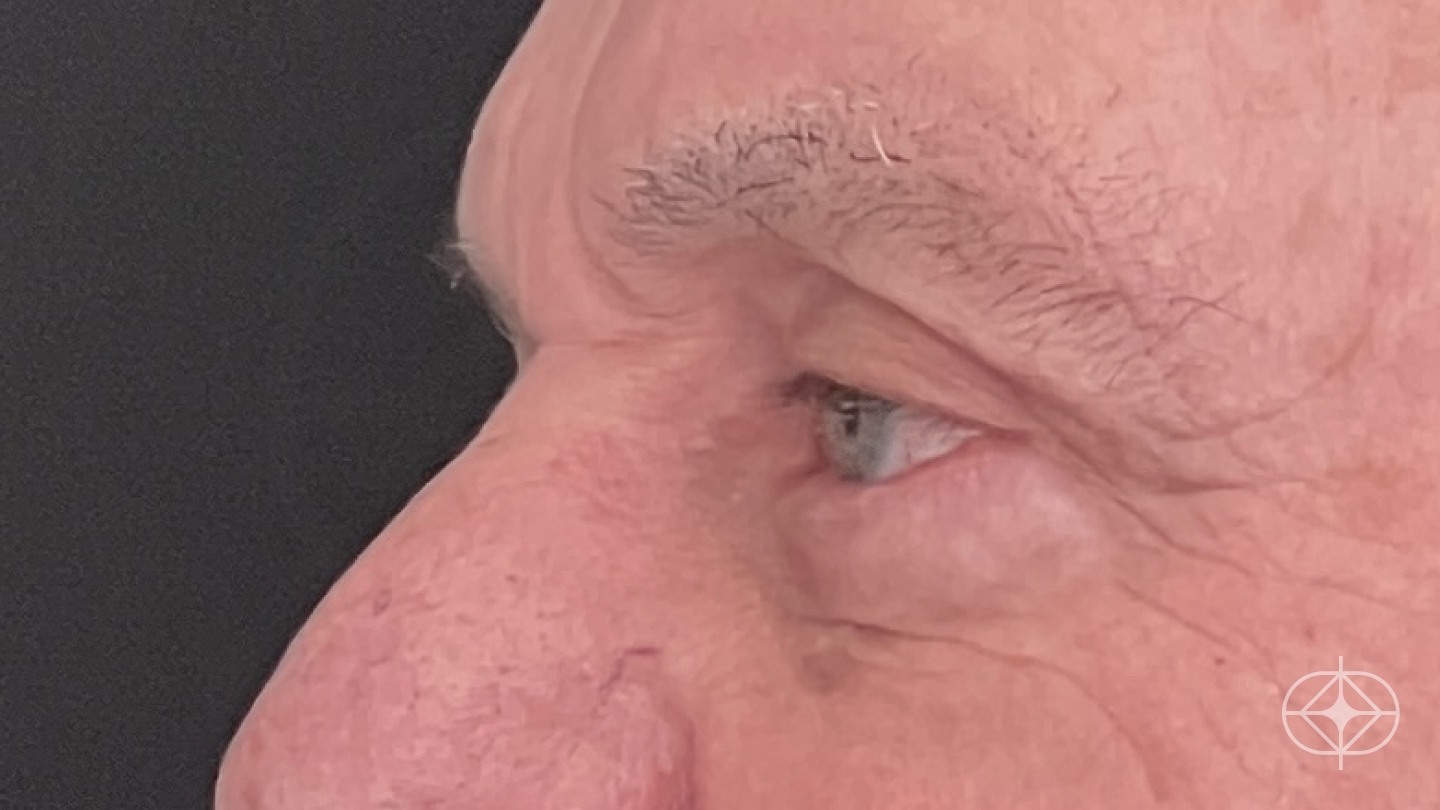 Resultado após Blefaroplastia (olhos) realizado por Dr. Leandro Akio Tomita