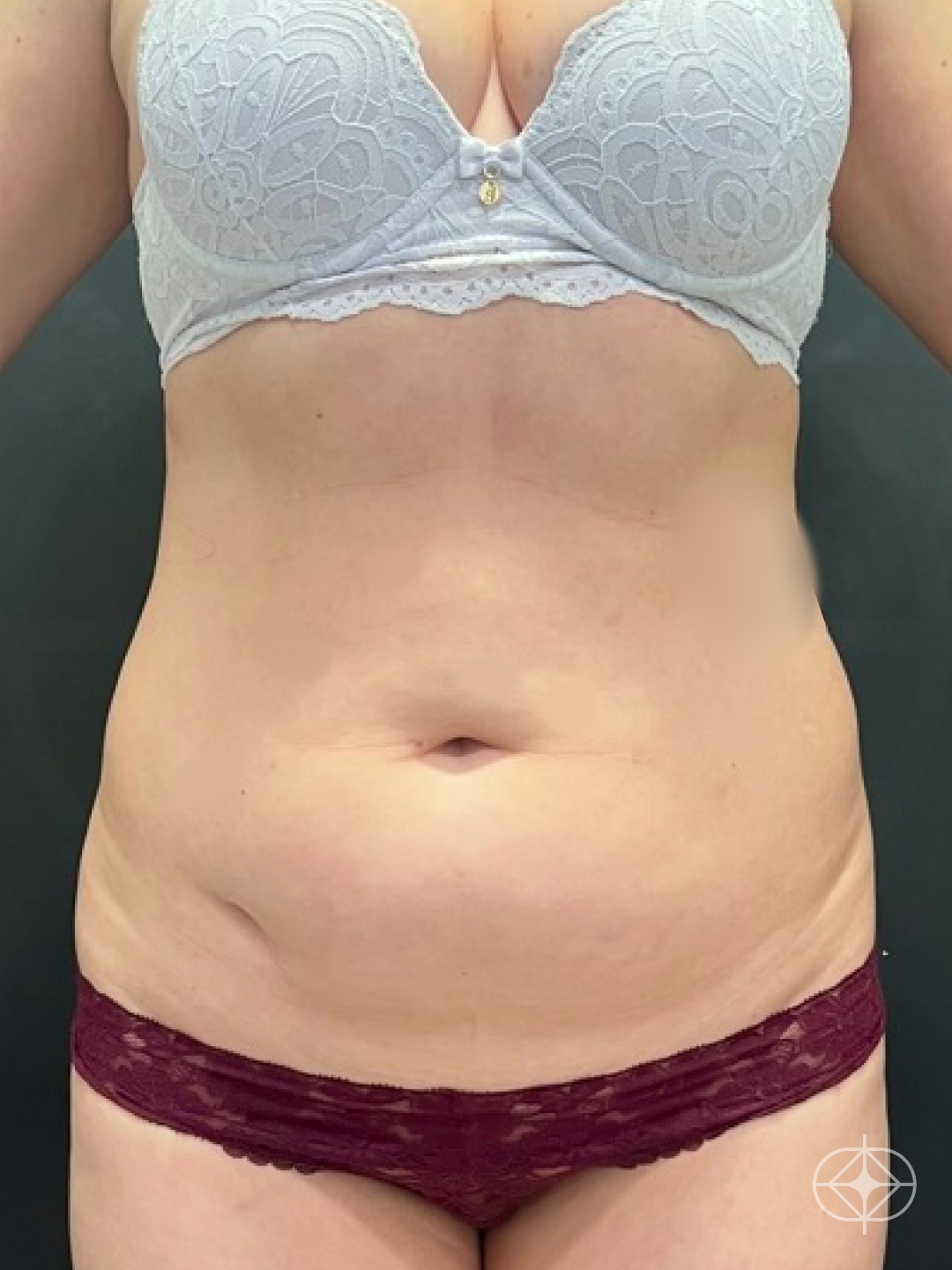 Foto antes de Abdominoplastia realizado por Dr. Felipe de David