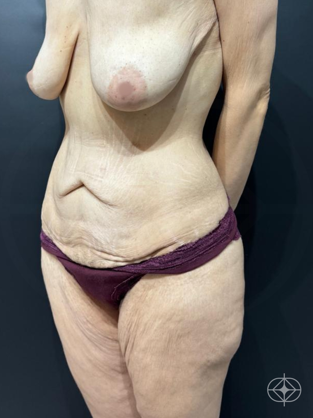 Foto antes de Abdominoplastia realizado por Dra. Monica Renesto Fontana Do Amaral