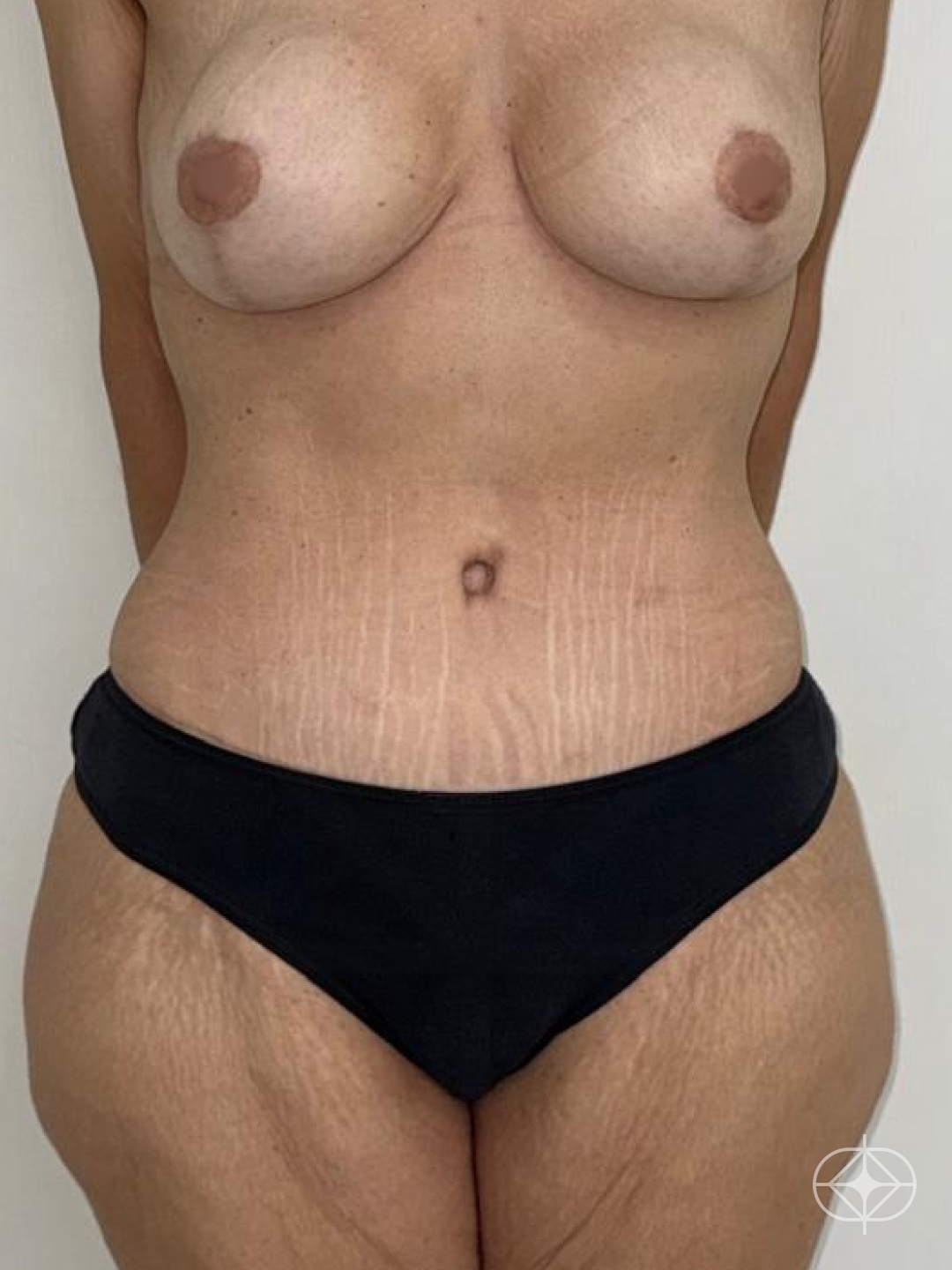Resultado após Abdominoplastia realizado por Dra. Monica Renesto Fontana Do Amaral