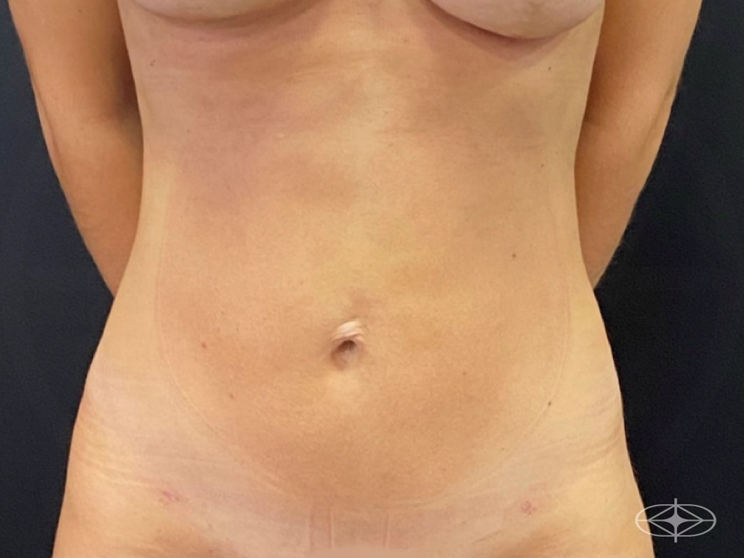 Resultado após Lipoaspiração / Lipo HD realizado por Dr. Henrique Riggenbach Muller