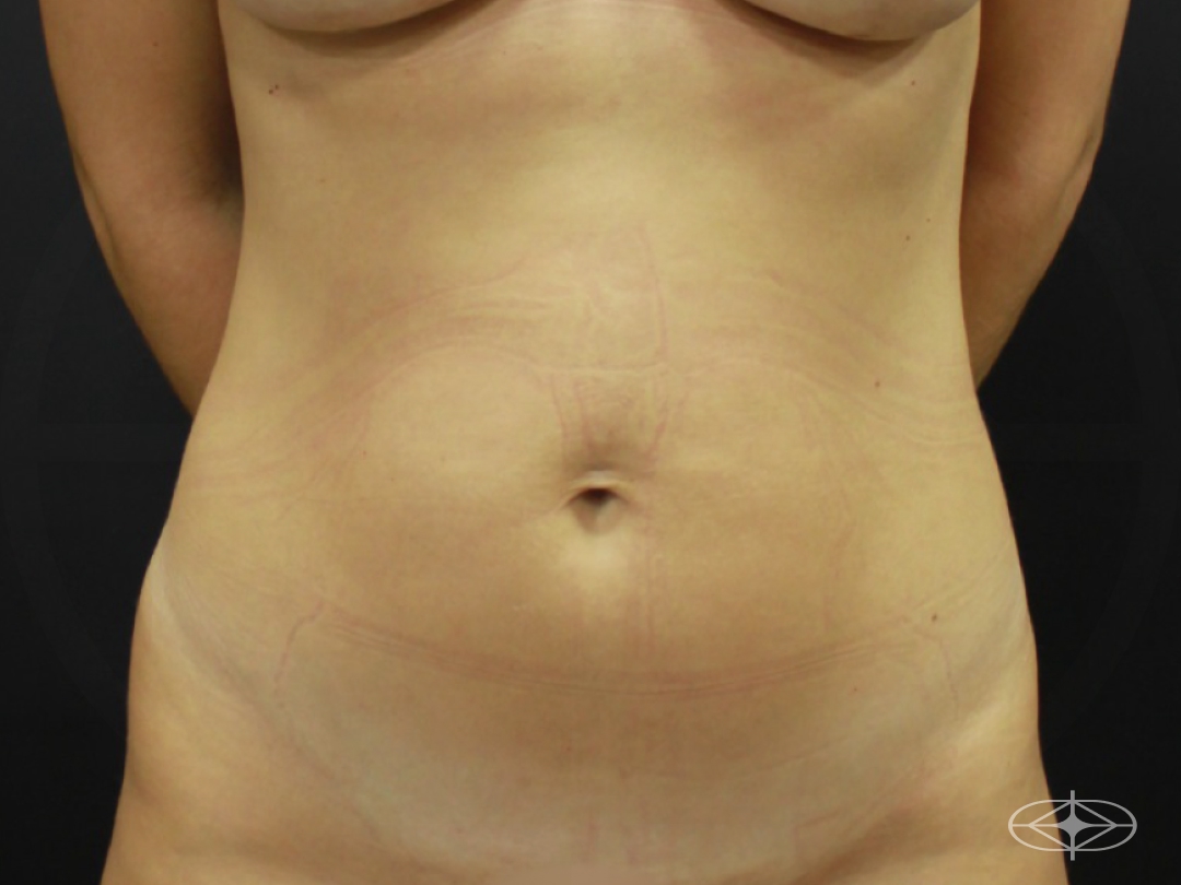 Foto antes de Lipoaspiração / Lipo HD realizado por Dr. Henrique Riggenbach Muller