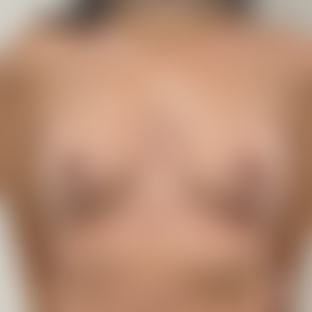 Resultado após Mastopexia sem Prótese realizado por Dr. Ricardo Votto
