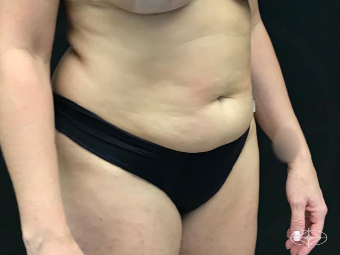 Foto antes de Lipoaspiração / Lipo HD realizado por Dr. William Seidel