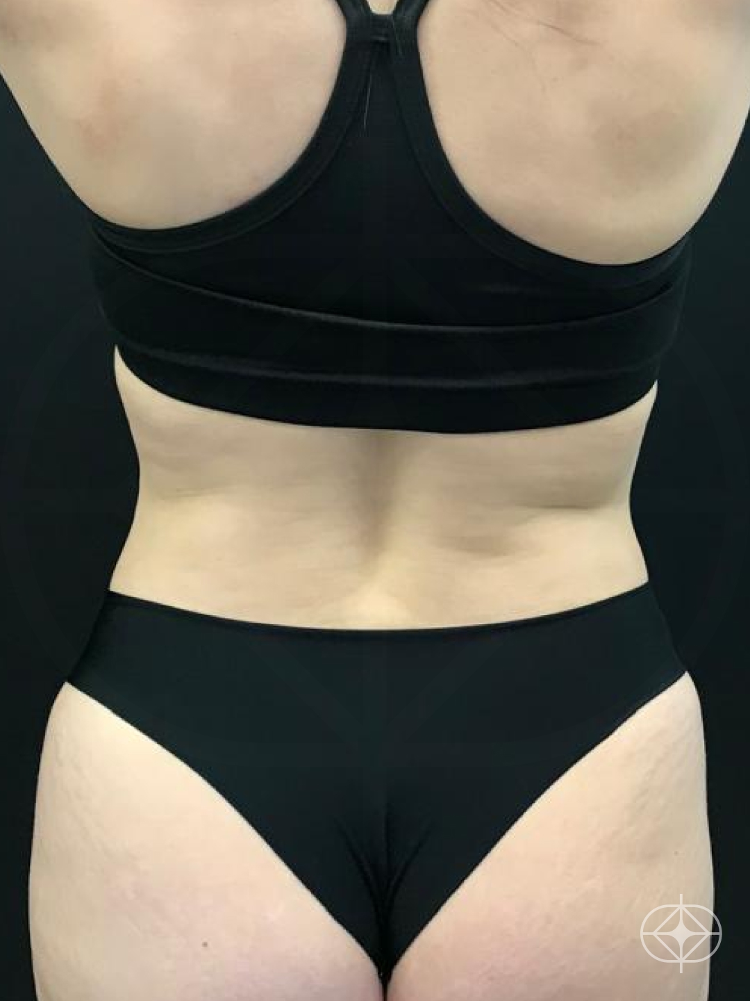 Resultado após Lipoaspiração / Lipo HD realizado por Dr. William Seidel