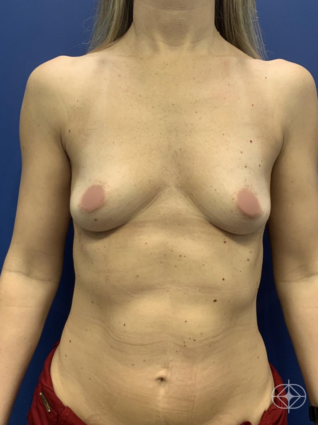 Prótese de Mama / Mamoplastia (silicone) - Pré