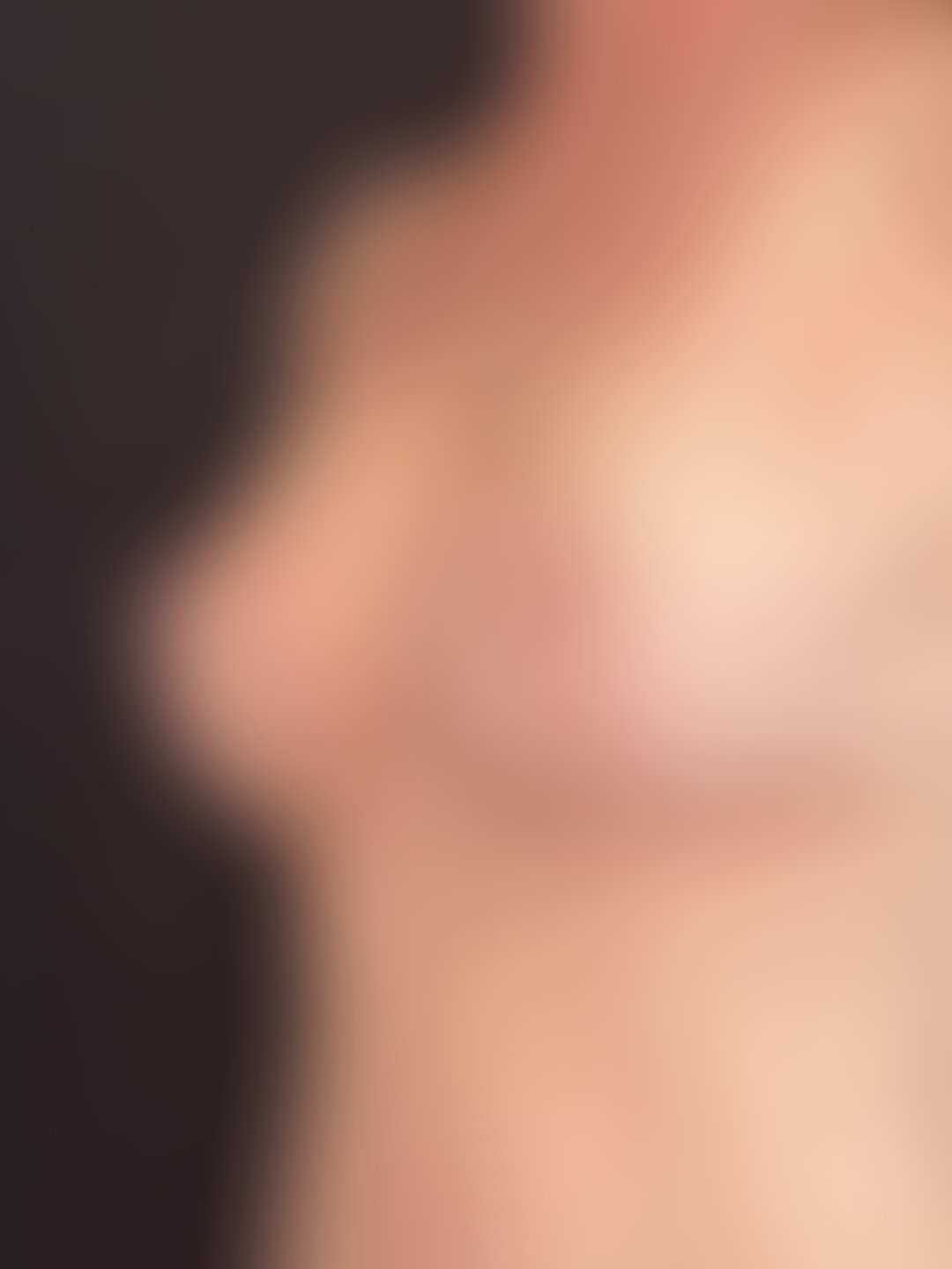 Resultado após Mamoplastia Redutora realizado por Dr. Leandro Akio Tomita