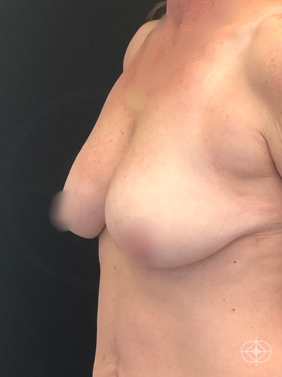 Foto antes de Mamoplastia Redutora realizado por Dr. Leandro Akio Tomita