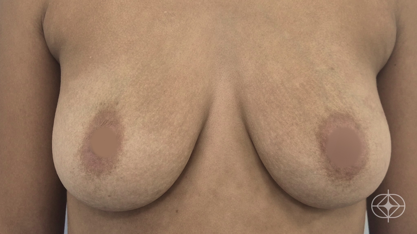 Foto antes de Reconstrução Mamária (mastectomia) realizado por Dr. Adriano Oliveira