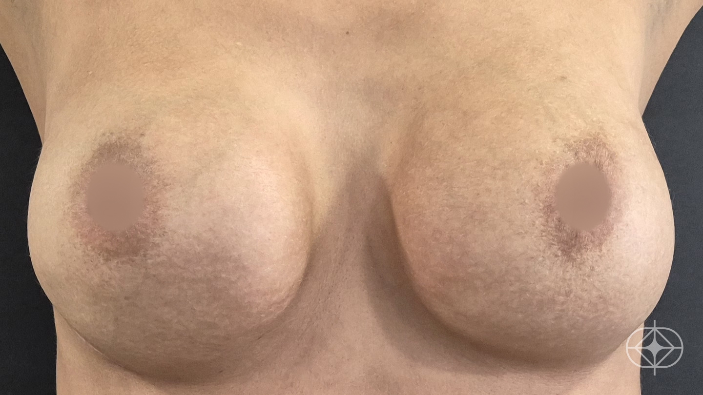 Resultado após Reconstrução Mamária (mastectomia) realizado por Dr. Adriano Oliveira