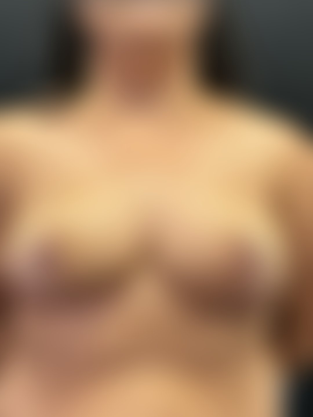 Resultado após Mamoplastia Redutora realizado por Dr. Henrique Riggenbach Muller