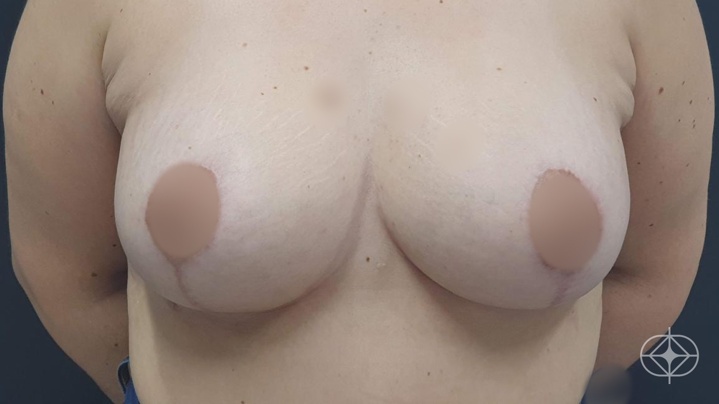 Resultado após Mastopexia com Prótese (silicone) realizado por Dr. Eduardo Fraga