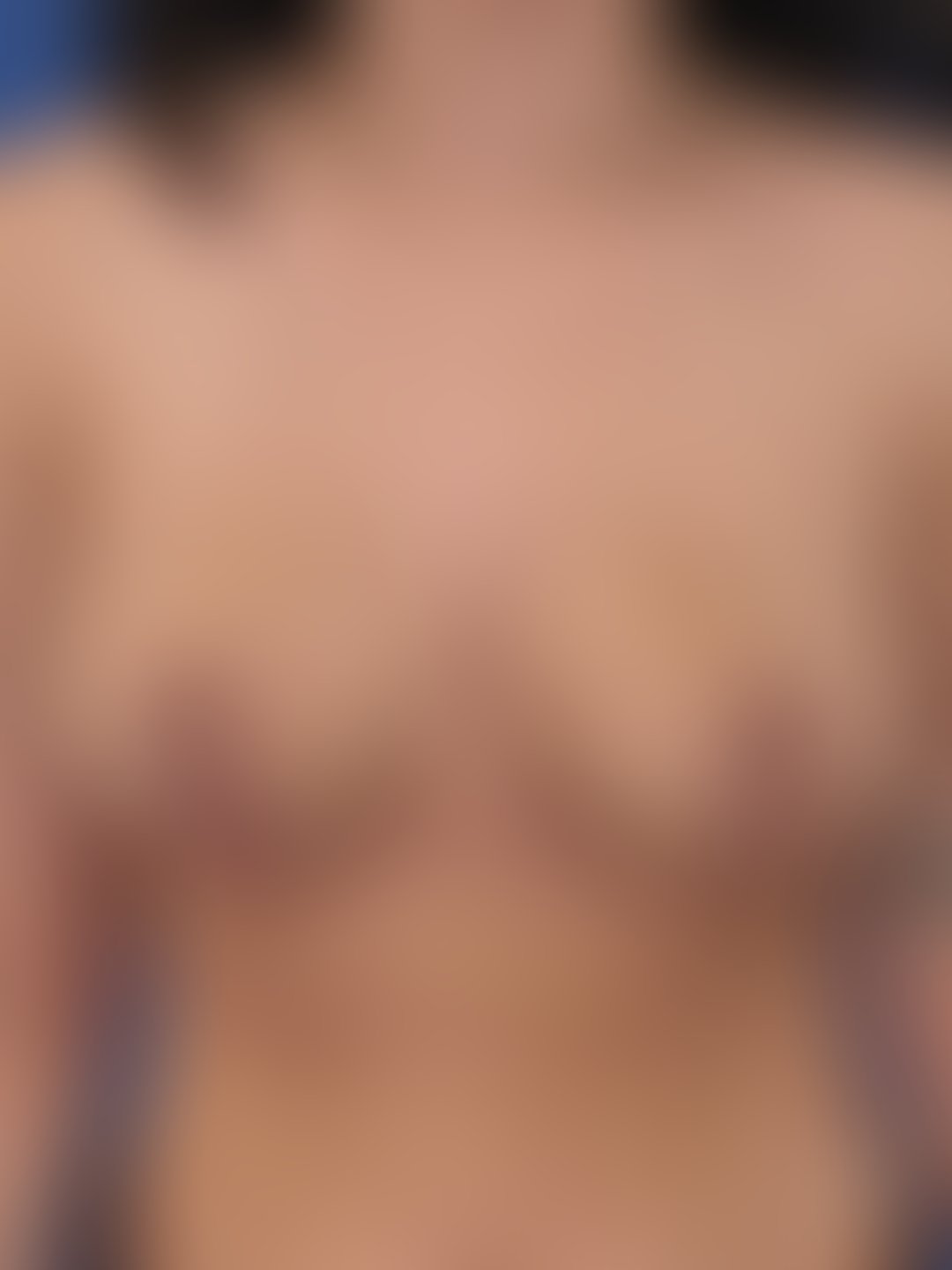Resultado após Mamoplastia Redutora realizado por Dr. Manoel Bizerra