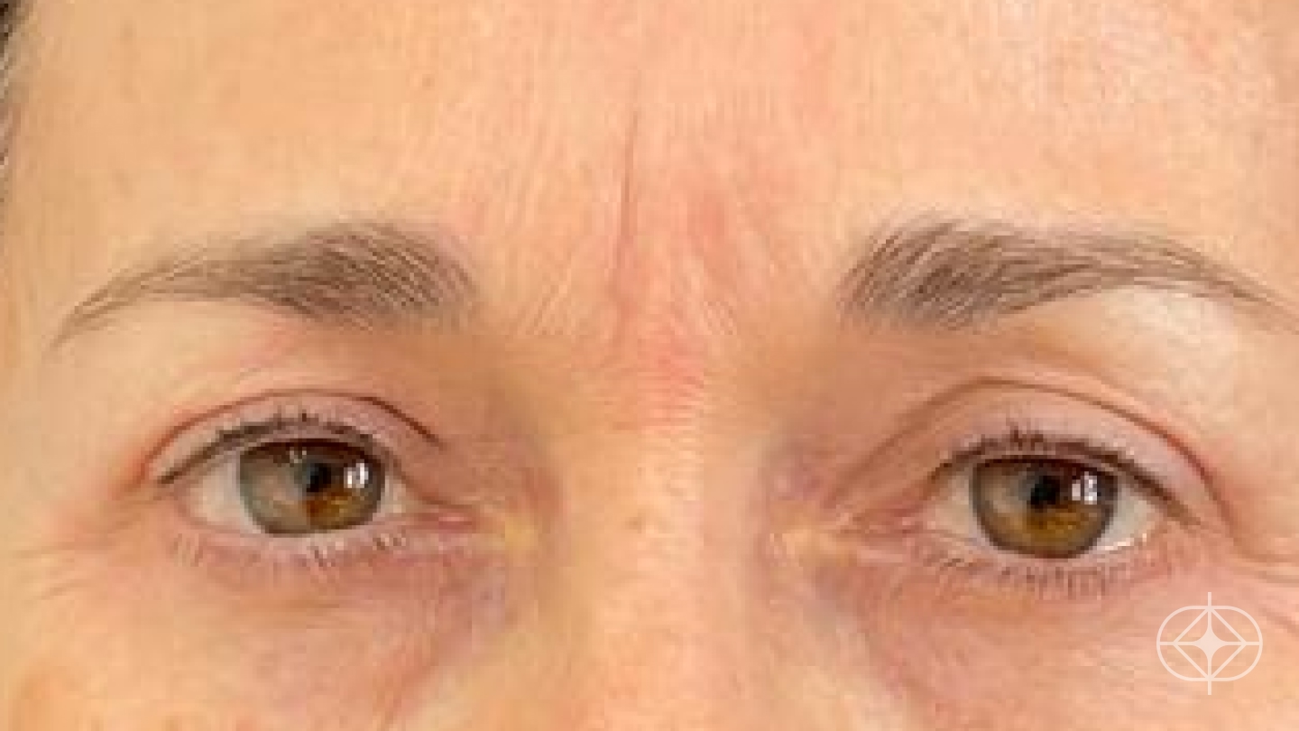 Resultado após Blefaroplastia (olhos) realizado por Dra. Monica Renesto Fontana Do Amaral