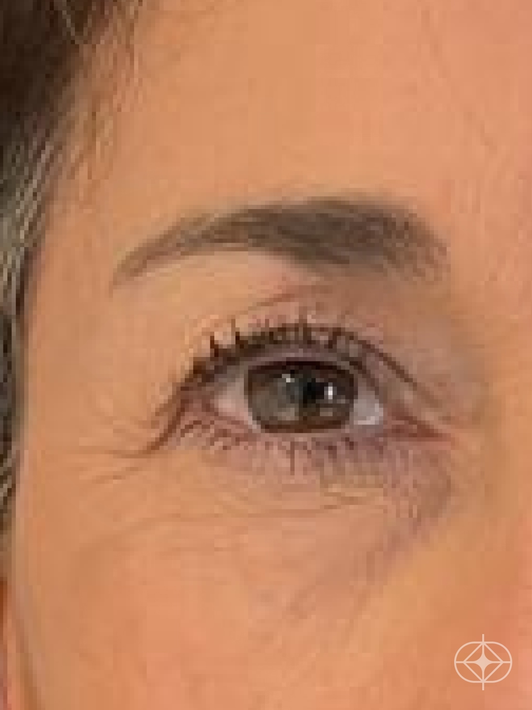 Foto antes de Blefaroplastia (olhos) realizado por Dra. Monica Renesto Fontana Do Amaral