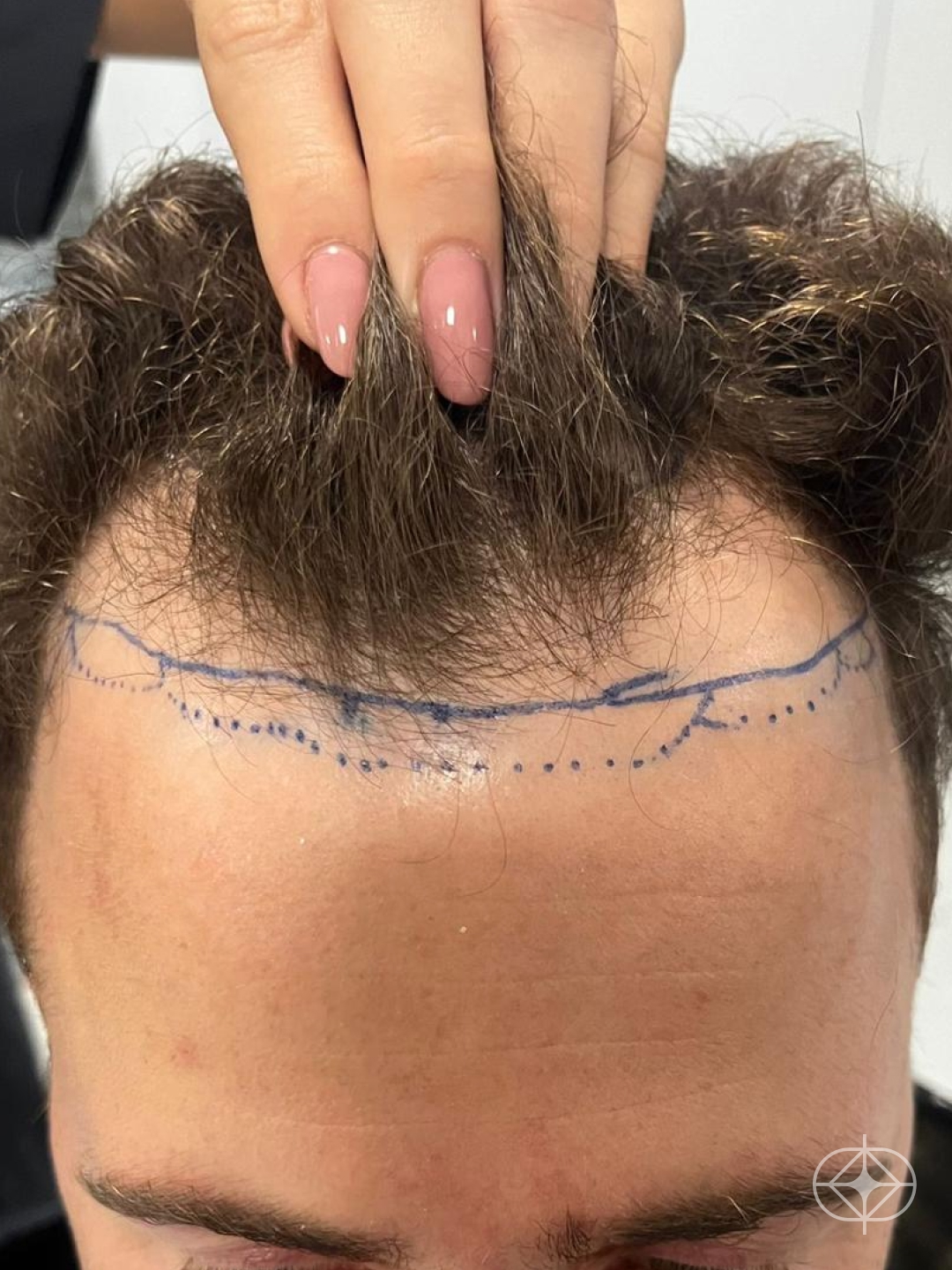 Foto antes de Transplante Capilar (cabelo) realizado por Dra. Fernanda Vicente