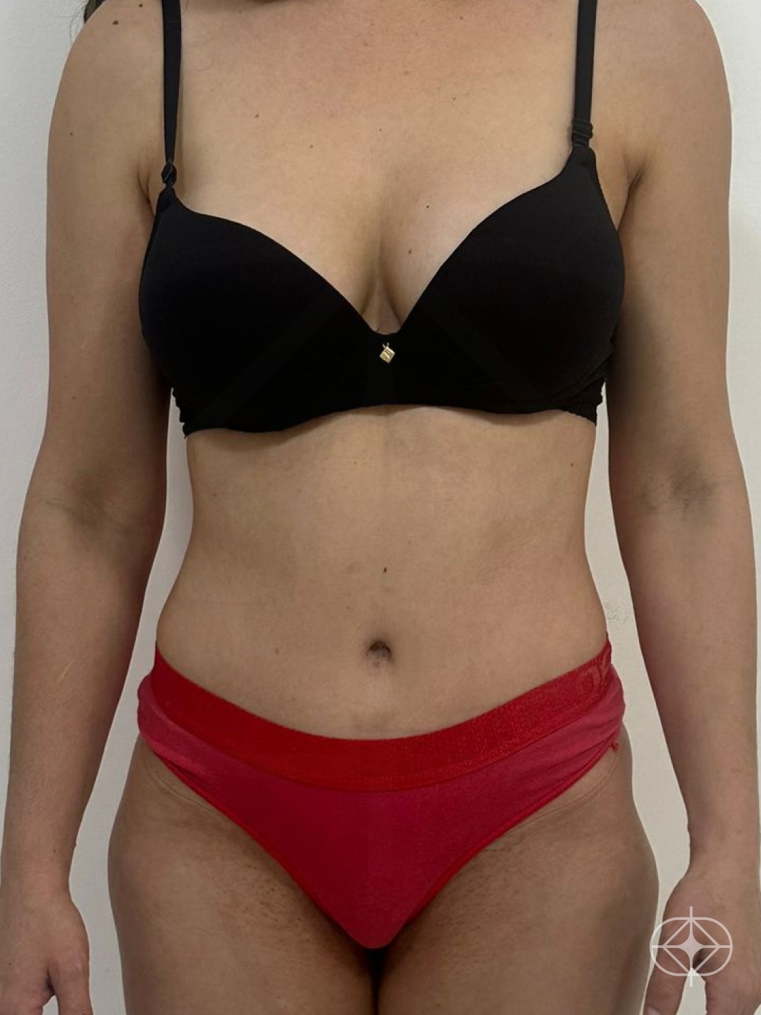 Resultado após Lipoaspiração / Lipo HD realizado por Dr. João Ferreira
