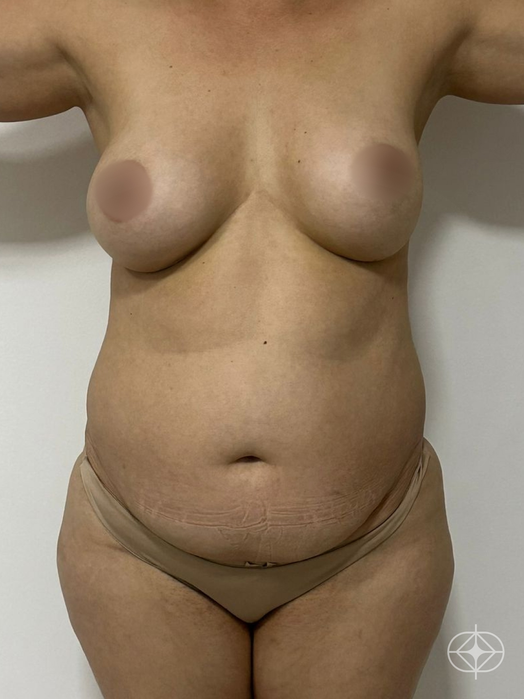 Foto antes de Lipoaspiração / Lipo HD realizado por Dr. João Ferreira