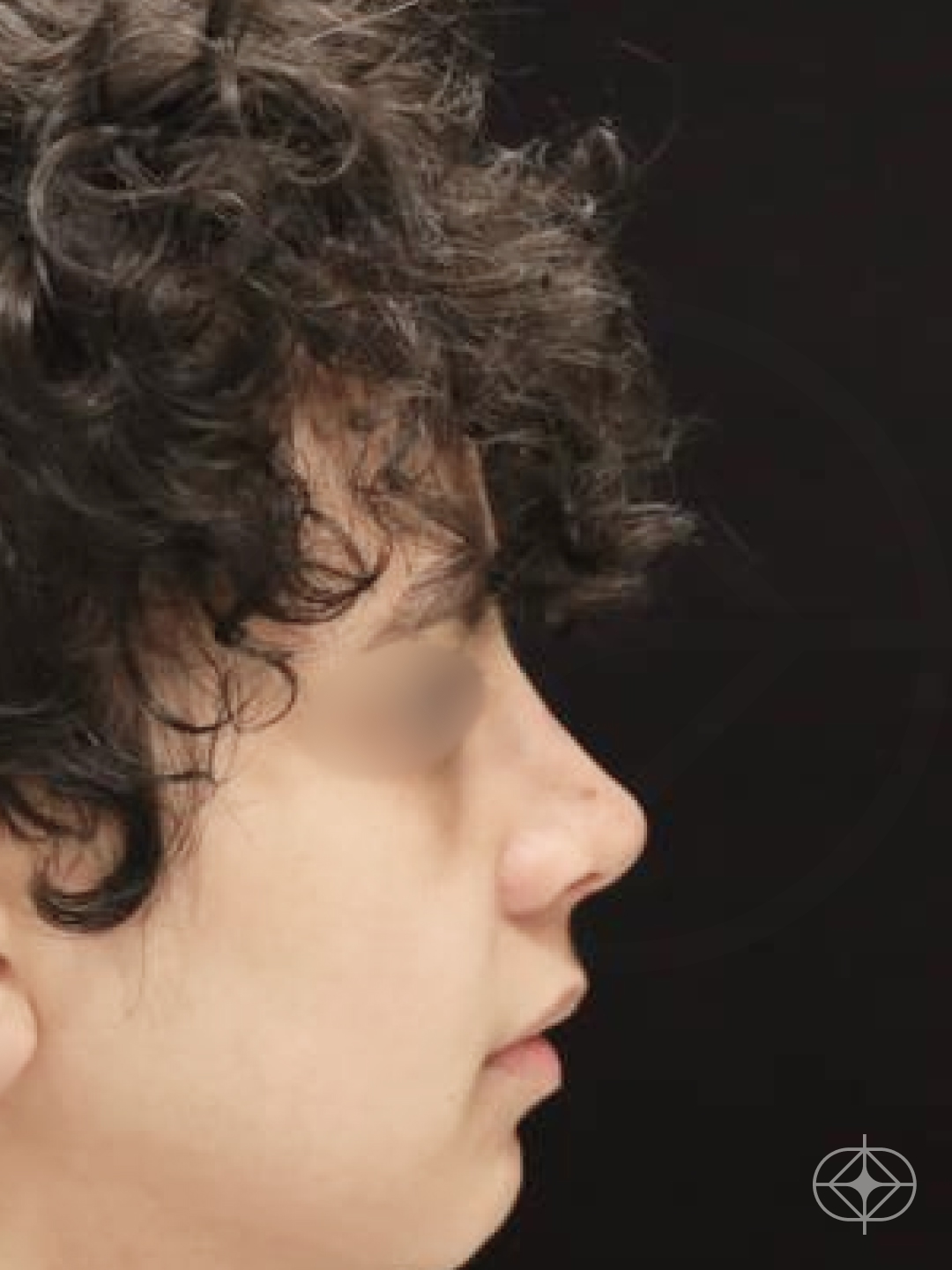 Resultado após Rinoplastia (nariz) realizado por Dr. Eduardo Zomer