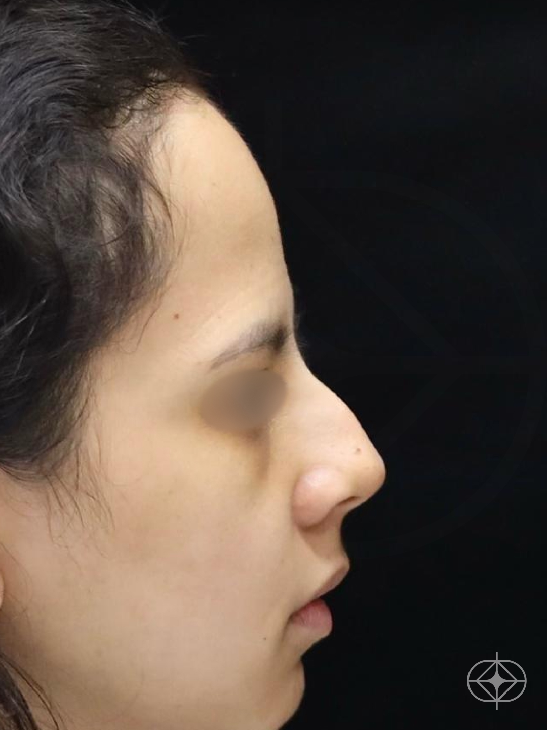 Foto antes de Rinoplastia (nariz) realizado por Dr. Eduardo Zomer