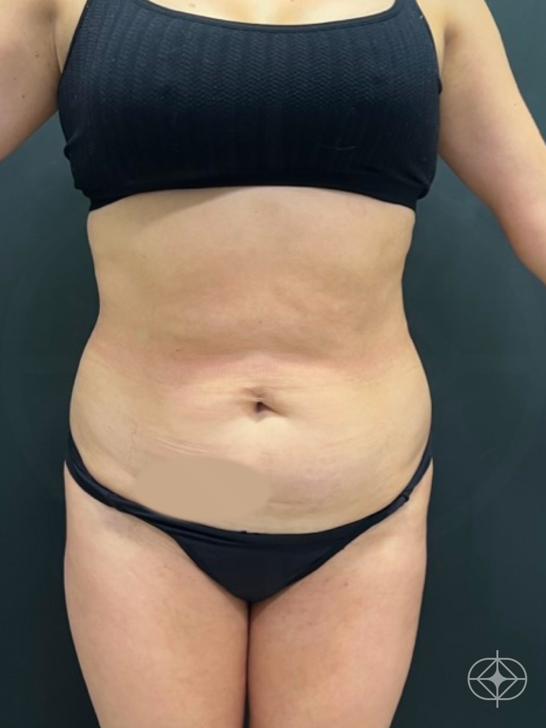Foto antes de Abdominoplastia realizado por Dr. Felipe de David