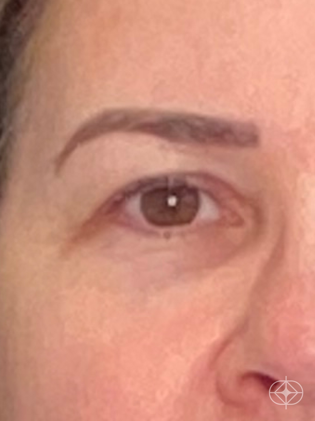 Foto antes de Blefaroplastia (olhos) realizado por Dr. Leandro Akio Tomita