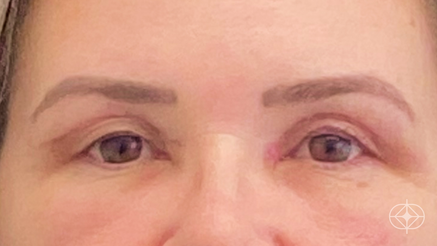 Resultado após Blefaroplastia (olhos) realizado por Dr. Leandro Akio Tomita