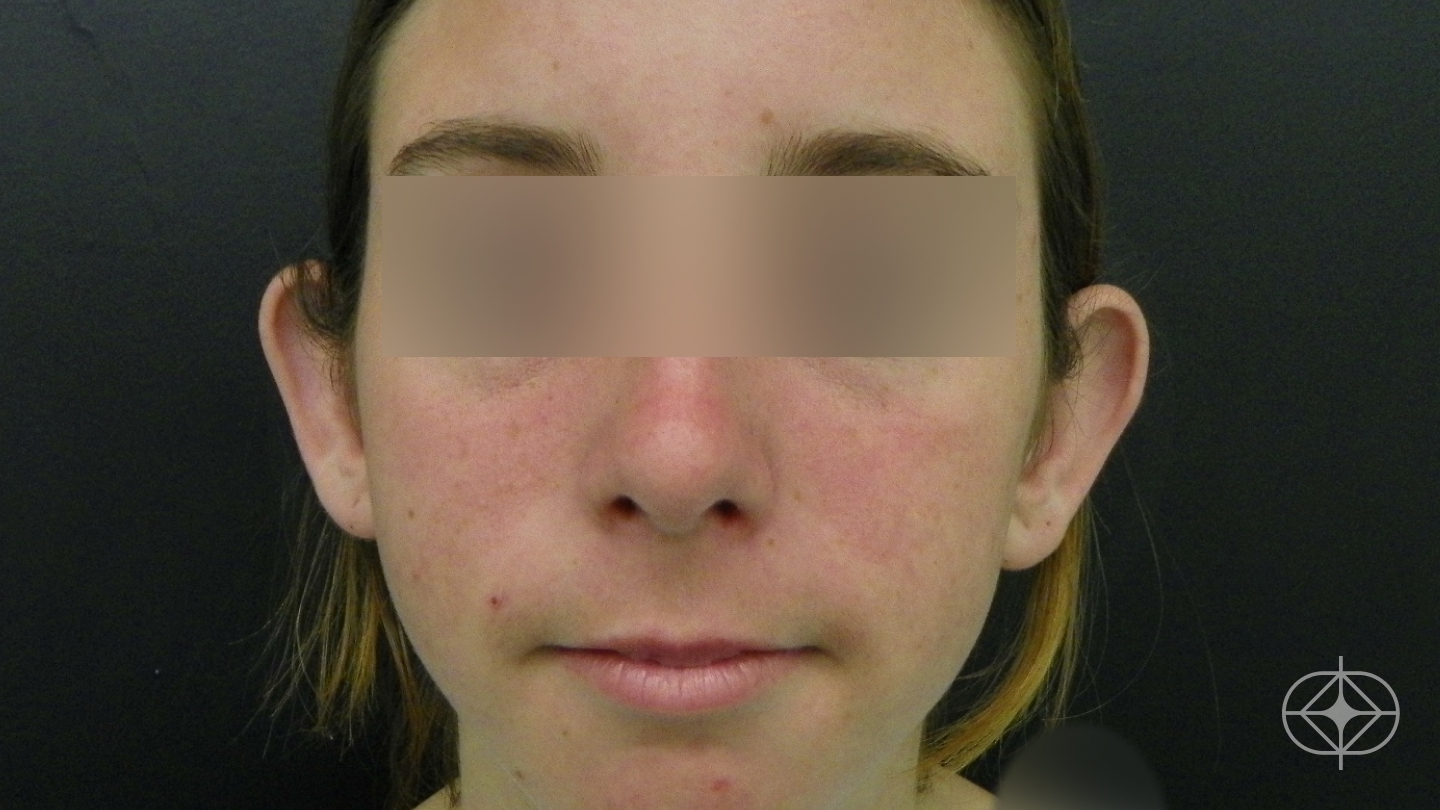 Foto antes de Otoplastia (orelhas) realizado por Dr. Wagner Santos