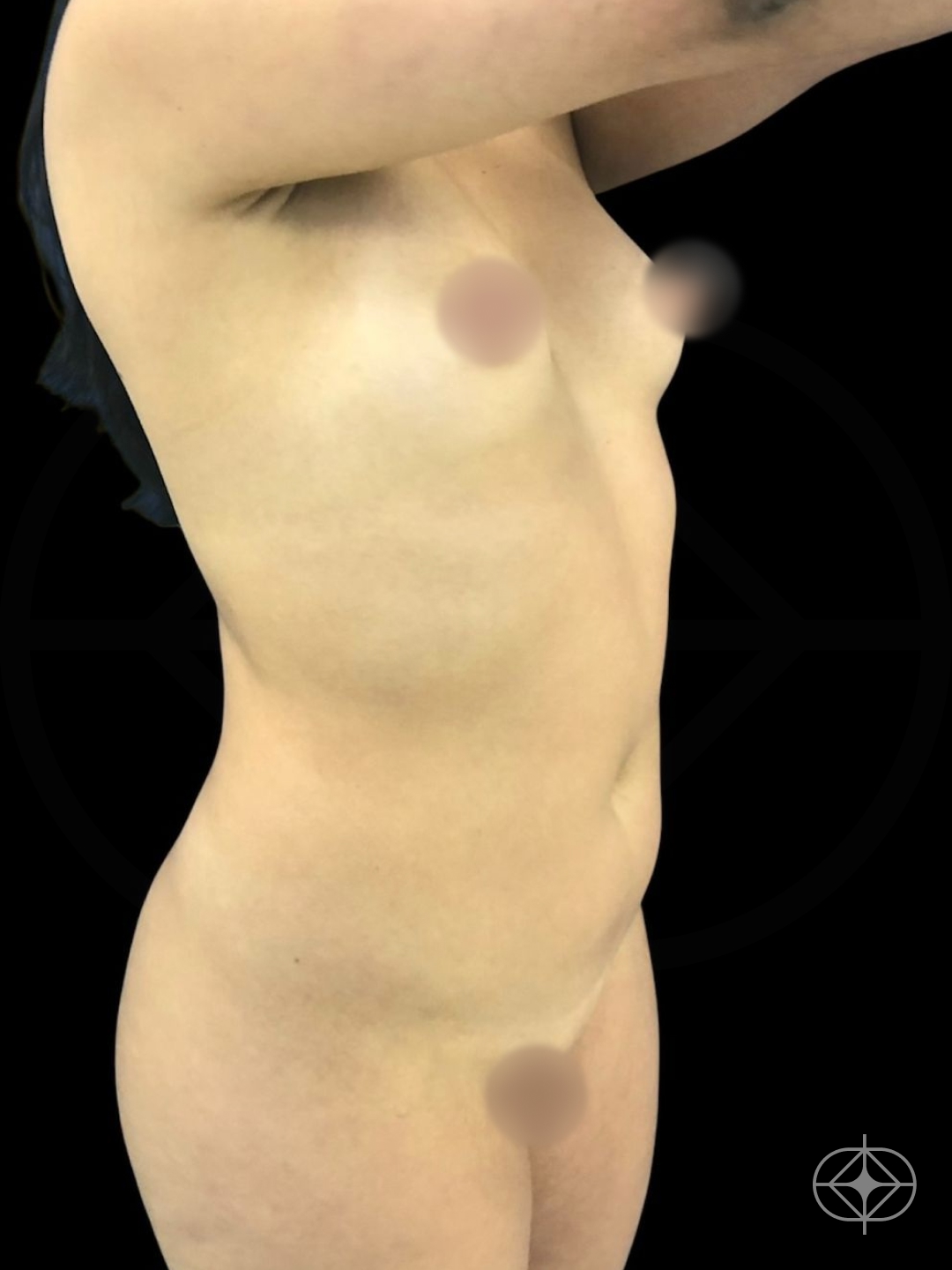 Foto antes de Lipoaspiração / Lipo HD realizado por Dr. Edgar Lopez Campos