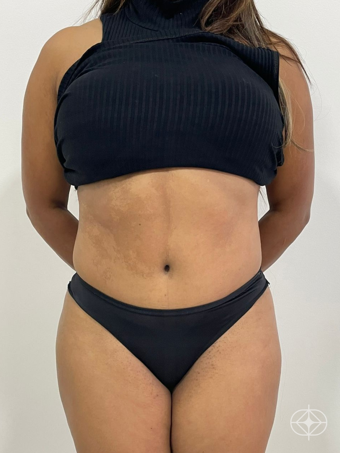 Resultado após Lipoaspiração / Lipo HD realizado por Dr. João Ferreira