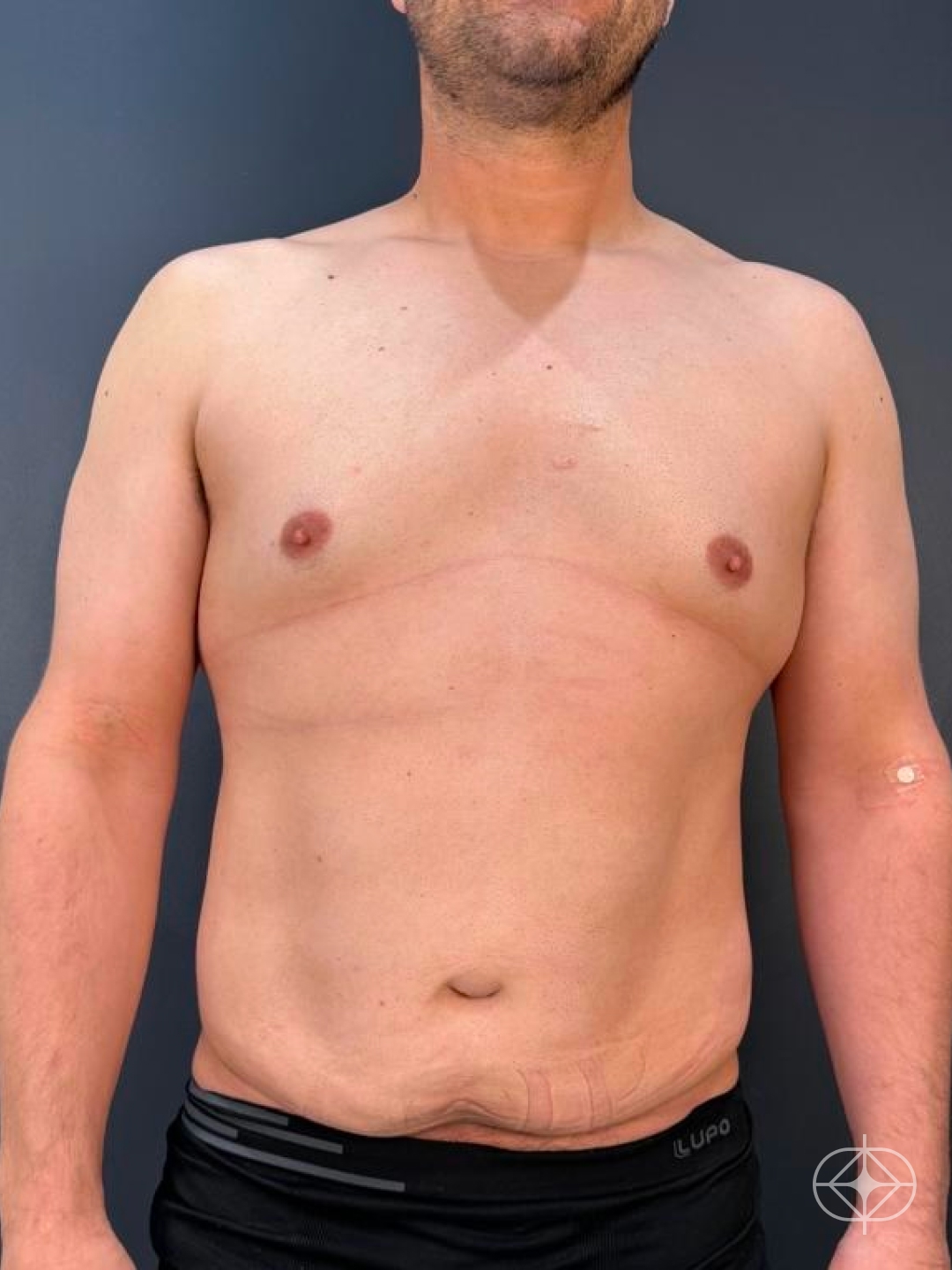 Foto antes de Lipoaspiração / Lipo HD realizado por Dr. Luis Fernando Bacarin