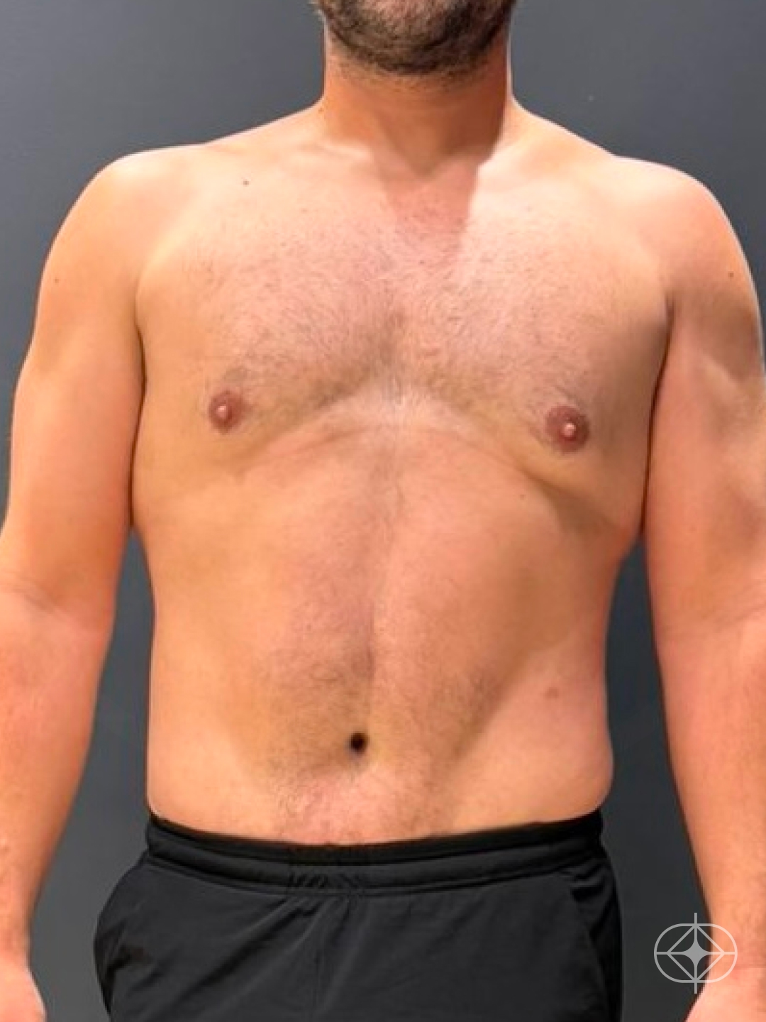 Resultado após Lipoaspiração / Lipo HD realizado por Dr. Luis Fernando Bacarin
