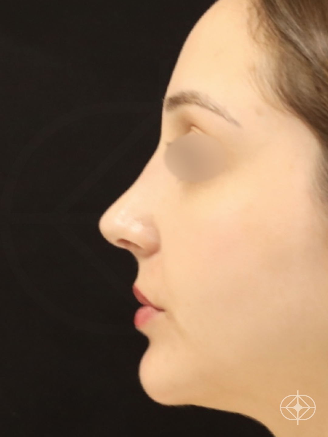Resultado após Rinoplastia (nariz) realizado por Dr. Eduardo Zomer