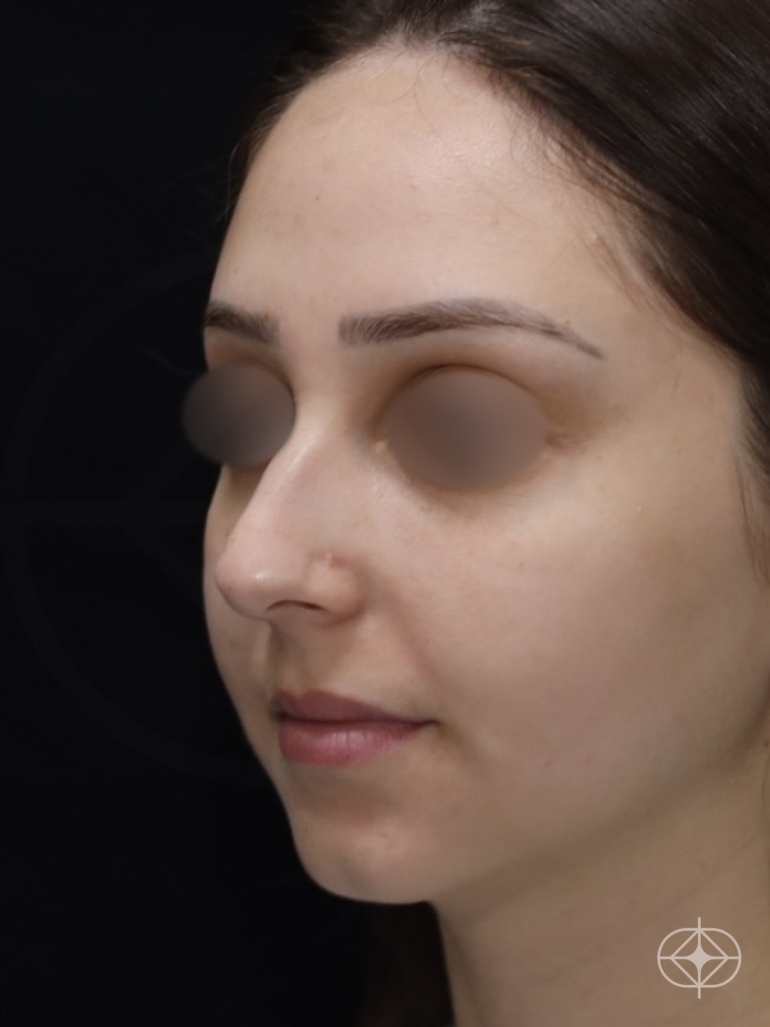 Foto antes de Rinoplastia (nariz) realizado por Dr. Eduardo Zomer
