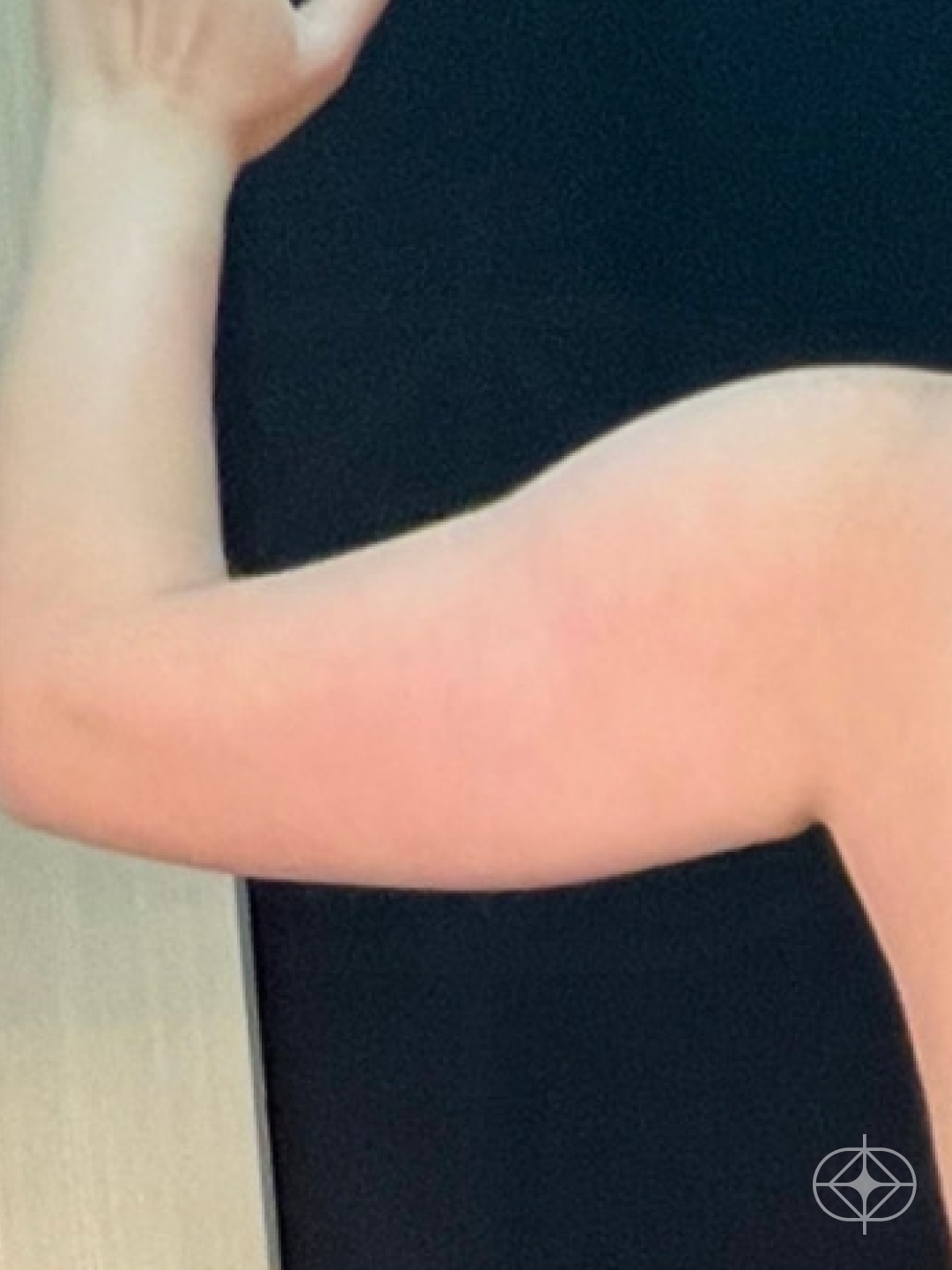 Foto antes de Lipoaspiração / Lipo HD realizado por Dr. Luis Fernando Bacarin