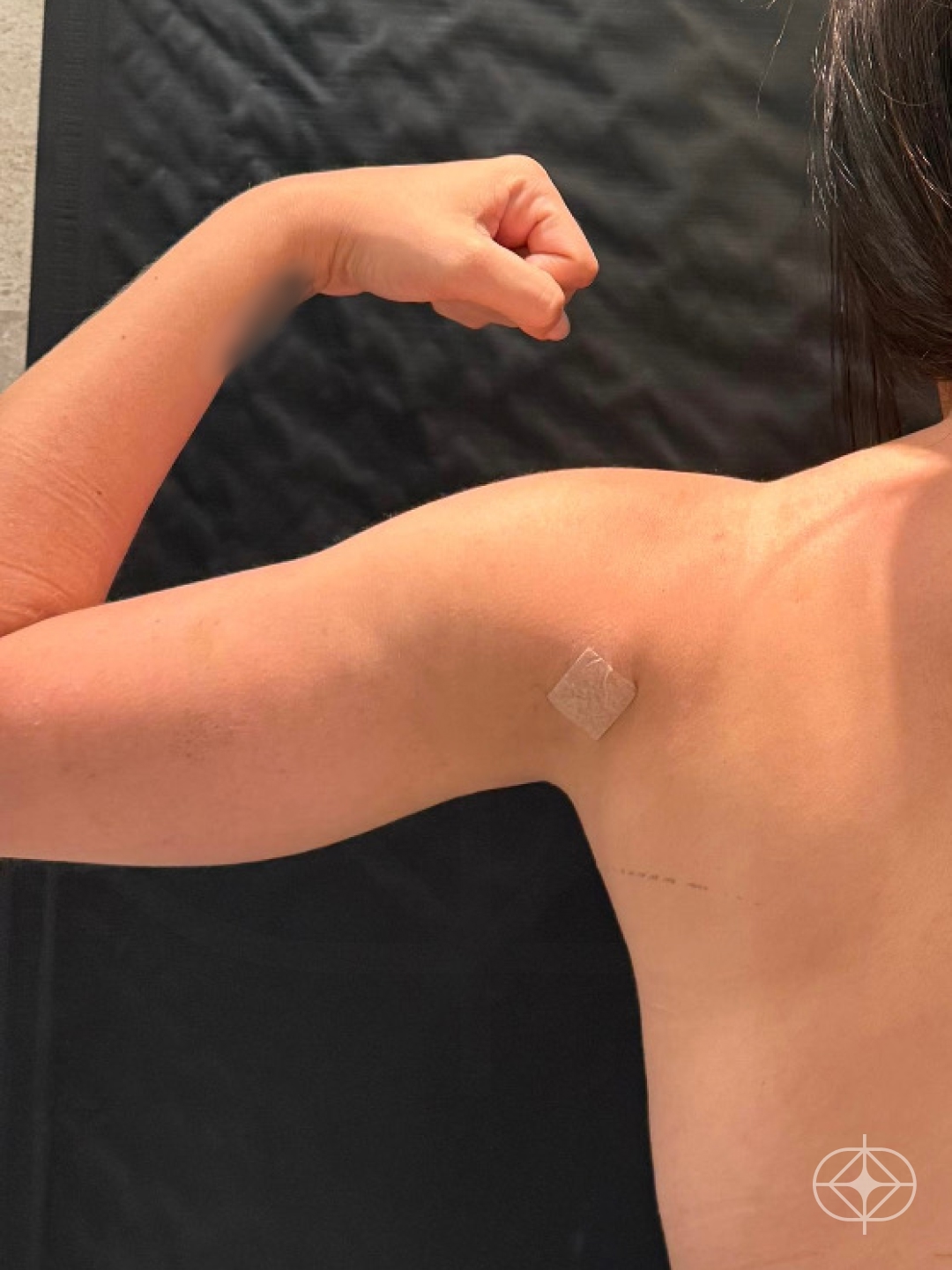 Resultado após Lipoaspiração / Lipo HD realizado por Dr. Luis Fernando Bacarin