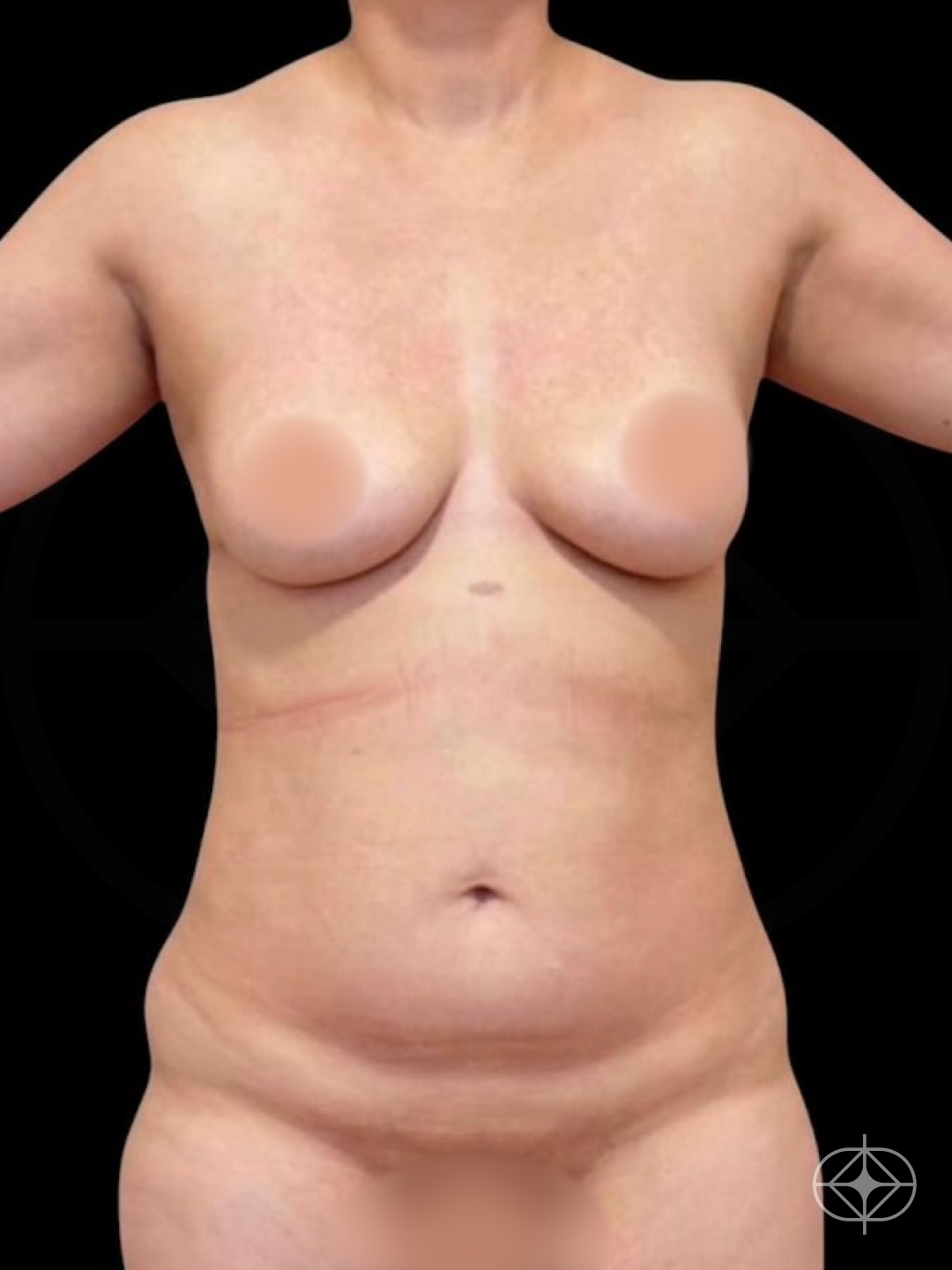 Foto antes de Lipoaspiração / Lipo HD realizado por Dr. Edgar Lopez Campos
