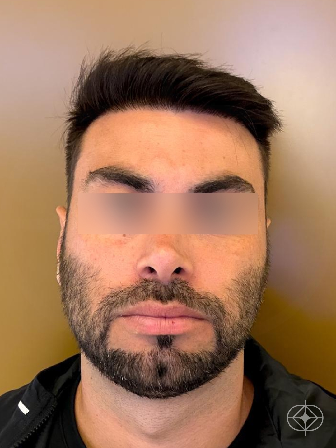 Transplante Capilar - Pós