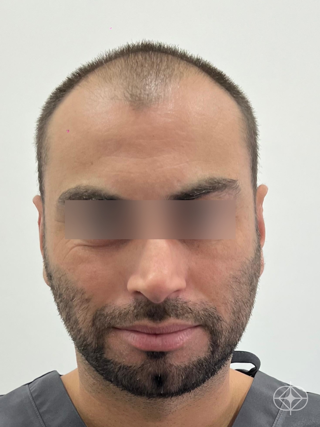 Transplante Capilar - Pré