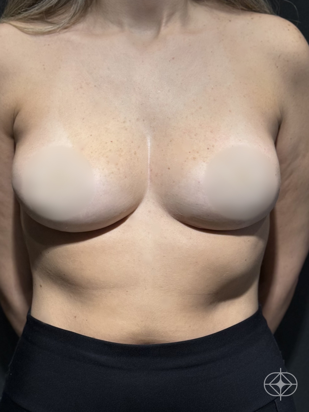Resultado após Mamoplastia Redutora realizado por Dr. Thiago Tubone